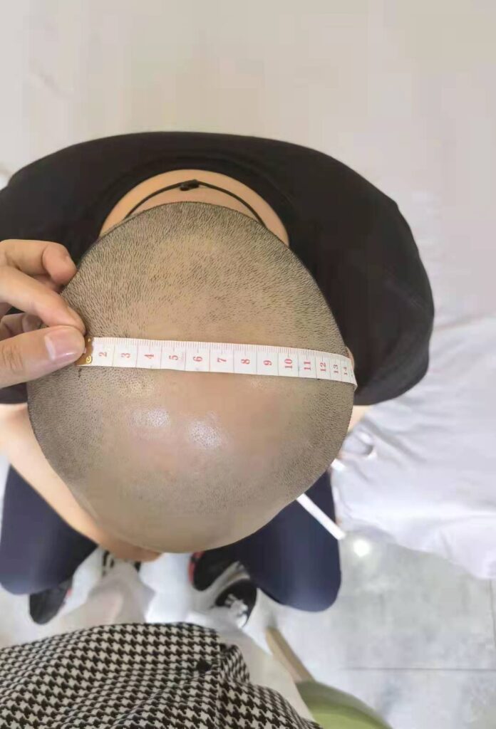 男士头皮佩戴头部测量(3)