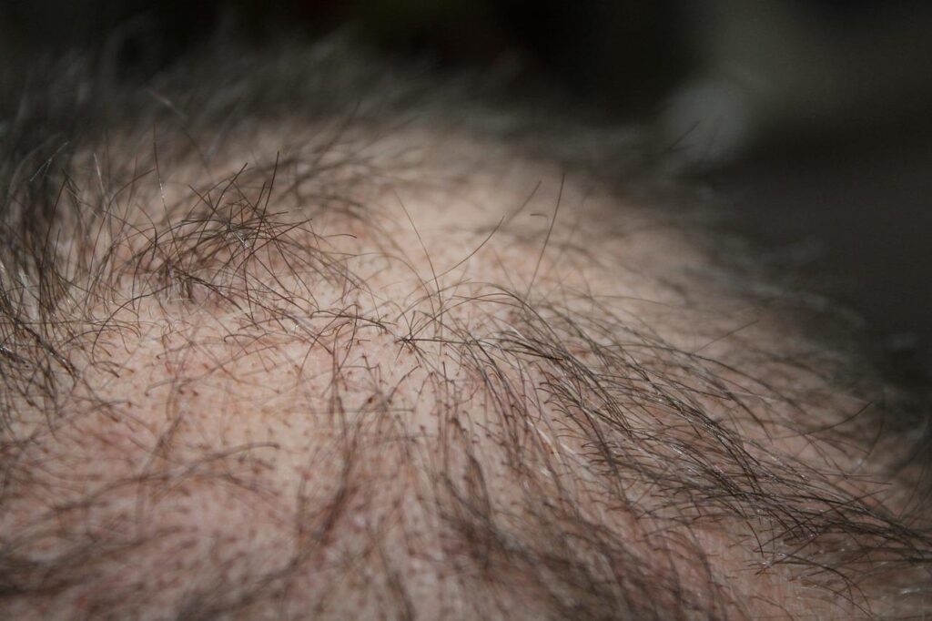hair, man, hair loss-248048.jpg
